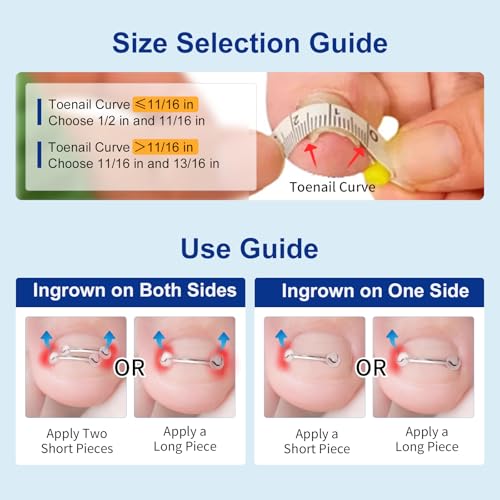 Nitinol Ingrown Toenail Corrector,at Home Ingrown Toenail Treatment,Curved Toenail Straightener,Ingrown Toe Nail Relief,Ingrown Toenail Removal Kit (11/16 In,13/16 In) - size: 11/16 In,13/16 In
