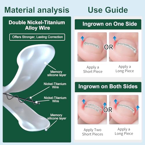 Dual Nitinol Ingrown Toenail Corrector,Ingrown Toenail Treatment,Curved Toenail Straightener,Ingrown Toenail Removal Kit,Big Toe Ingrown Toenail Tool (0.55in,0.66in) - size: 0.55in,0.66in