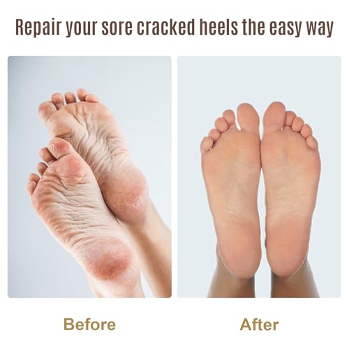 2PCS Foot File Foot Rasp Wooden Handle Pedicure Tool Foot Callus Remover Scrubber Dual-Sides Heel Grater for Dead Skin (1)