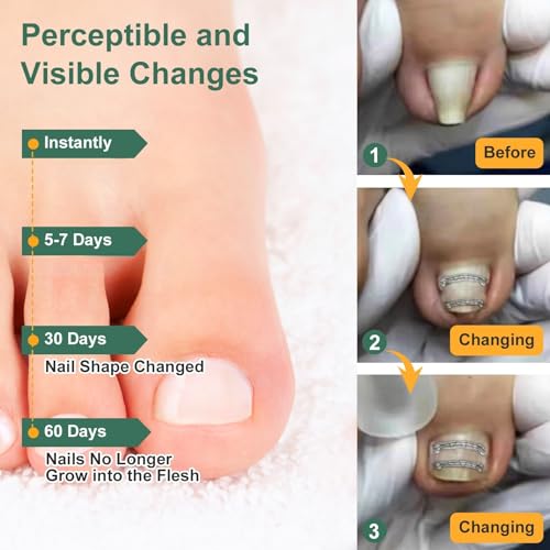 Dual Nitinol Ingrown Toenail Corrector,Ingrown Toenail Treatment,Curved Toenail Straightener,Ingrown Toenail Removal Kit,Big Toe Ingrown Toenail Tool (0.55in,0.66in) - size: 0.55in,0.66in