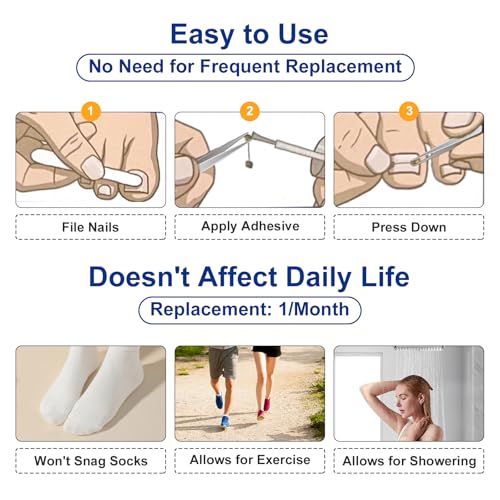 Nitinol Ingrown Toenail Corrector,at Home Ingrown Toenail Treatment,Curved Toenail Straightener,Ingrown Toe Nail Relief，Ingrown Toenail Removal Kit (11/16 In,13/16 In) - size: 11/16 In,13/16 In