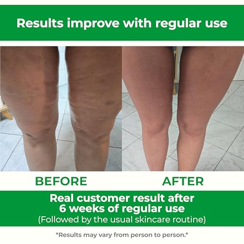 TESMED Cellulite Manual Massager Roller for Thighs and Buttocks | Made in Italy and patented, with converging and diverging roller technology for targeted anti-cellulite massage.