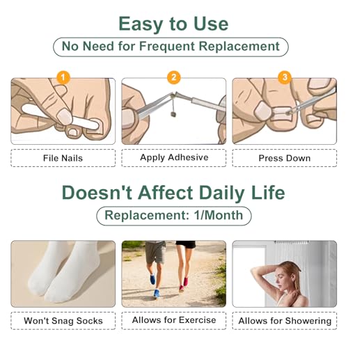 Dual Nitinol Ingrown Toenail Corrector,Ingrown Toenail Treatment,Curved Toenail Straightener,Ingrown Toenail Removal Kit,Big Toe Ingrown Toenail Tool (0.55in,0.66in) - size: 0.55in,0.66in
