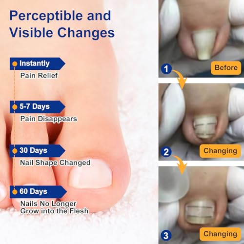 Nitinol Ingrown Toenail Corrector,at Home Ingrown Toenail Treatment,Curved Toenail Straightener,Ingrown Toe Nail Relief，Ingrown Toenail Removal Kit (1/2 In,11/16 In) - size: 1/2 In,11/16 In